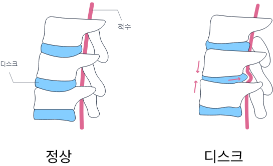 정상척추와 허리디스크가 발생한 상태의 척추를 비교하는 그림